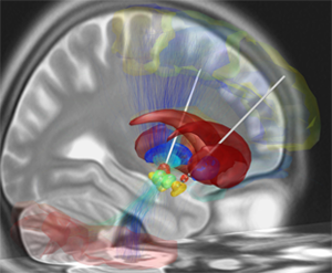 Illustration of deep brain stimulation Illustration of deep brain stimulation